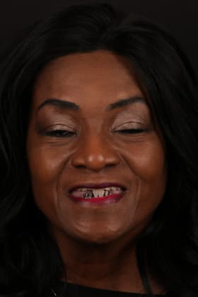 Before and after smile transformation by Advanced Dental Implant and TMJ Center in Southaven, MS.